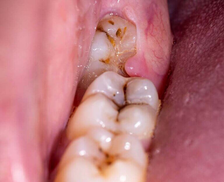 Impacted wisdom tooth