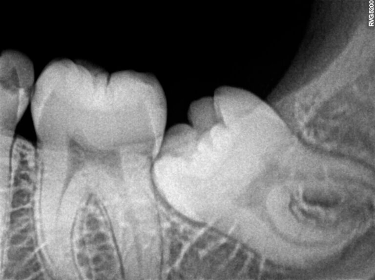 Impacted wisdom tooth xray