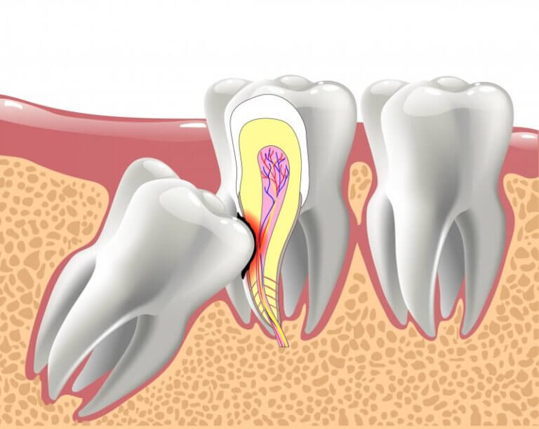 Impacted wisdom tooth