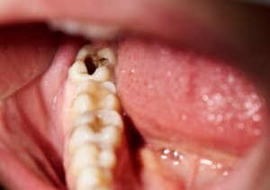Tooth decay on wisdom tooth