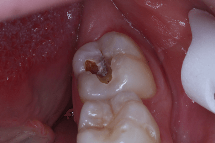 Tooth decay on wisdom tooth