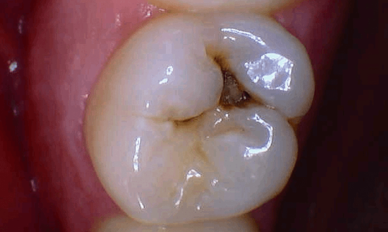 Tooth decay on wisdom tooth