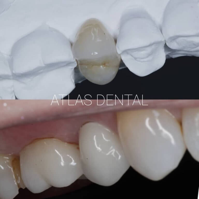 Dental Crown Toronto