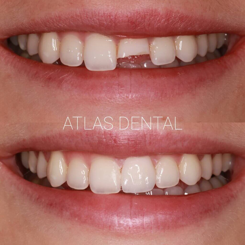 Dental Crown Toronto