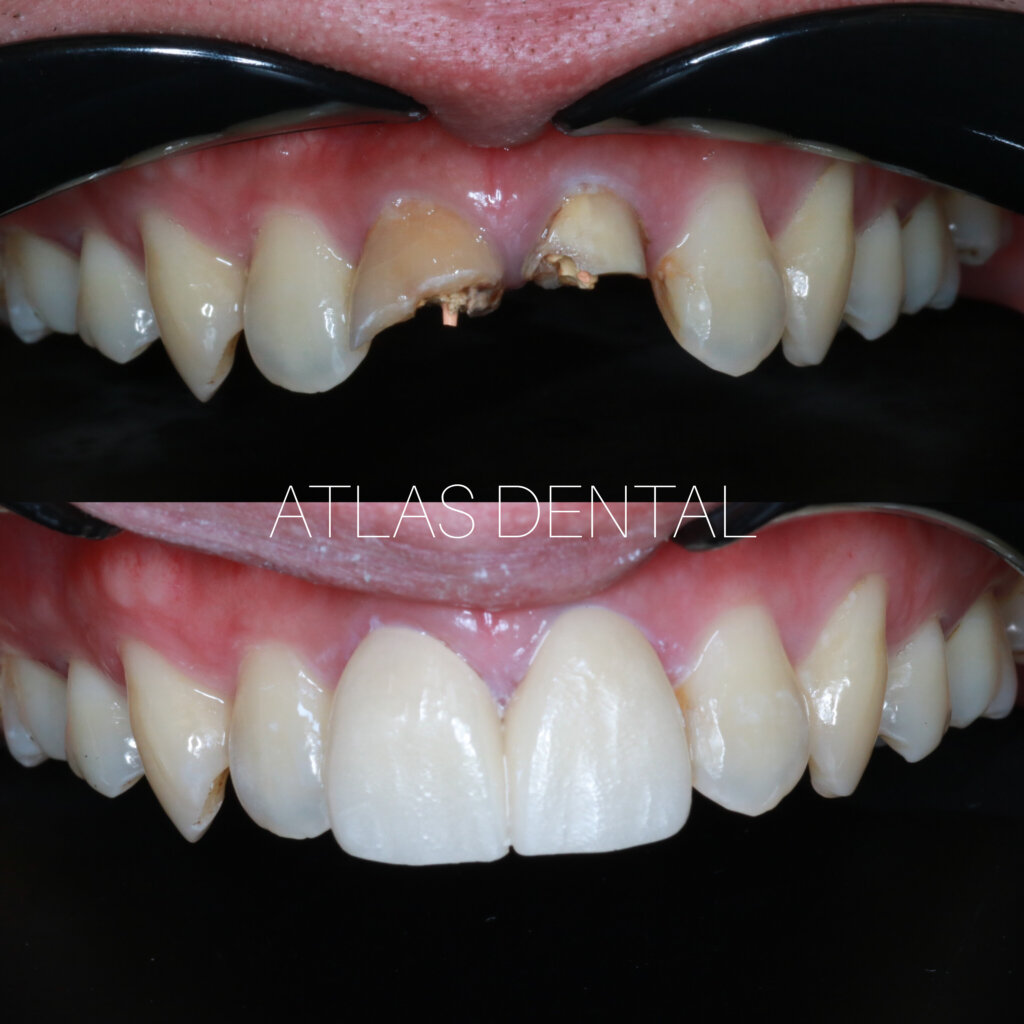 Dental Crowns Toronto