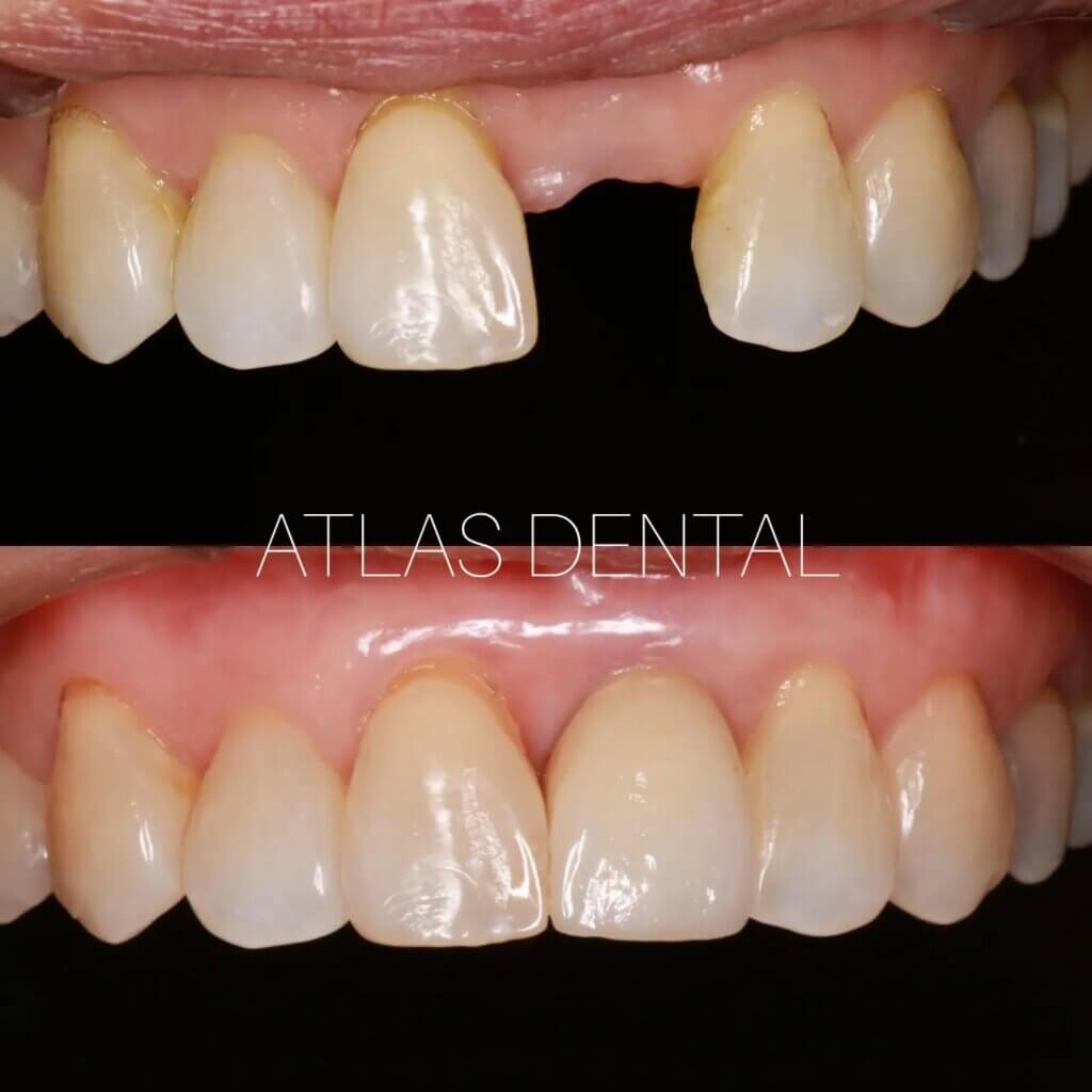 Dental Implant Toronto