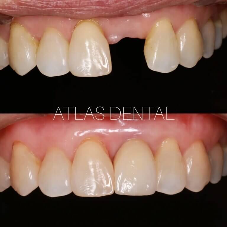 Dental Implant Toronto