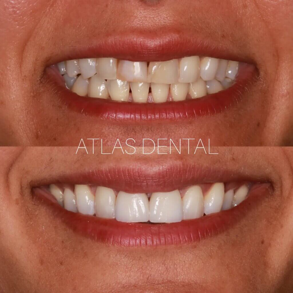 Dental Veneers Toronto