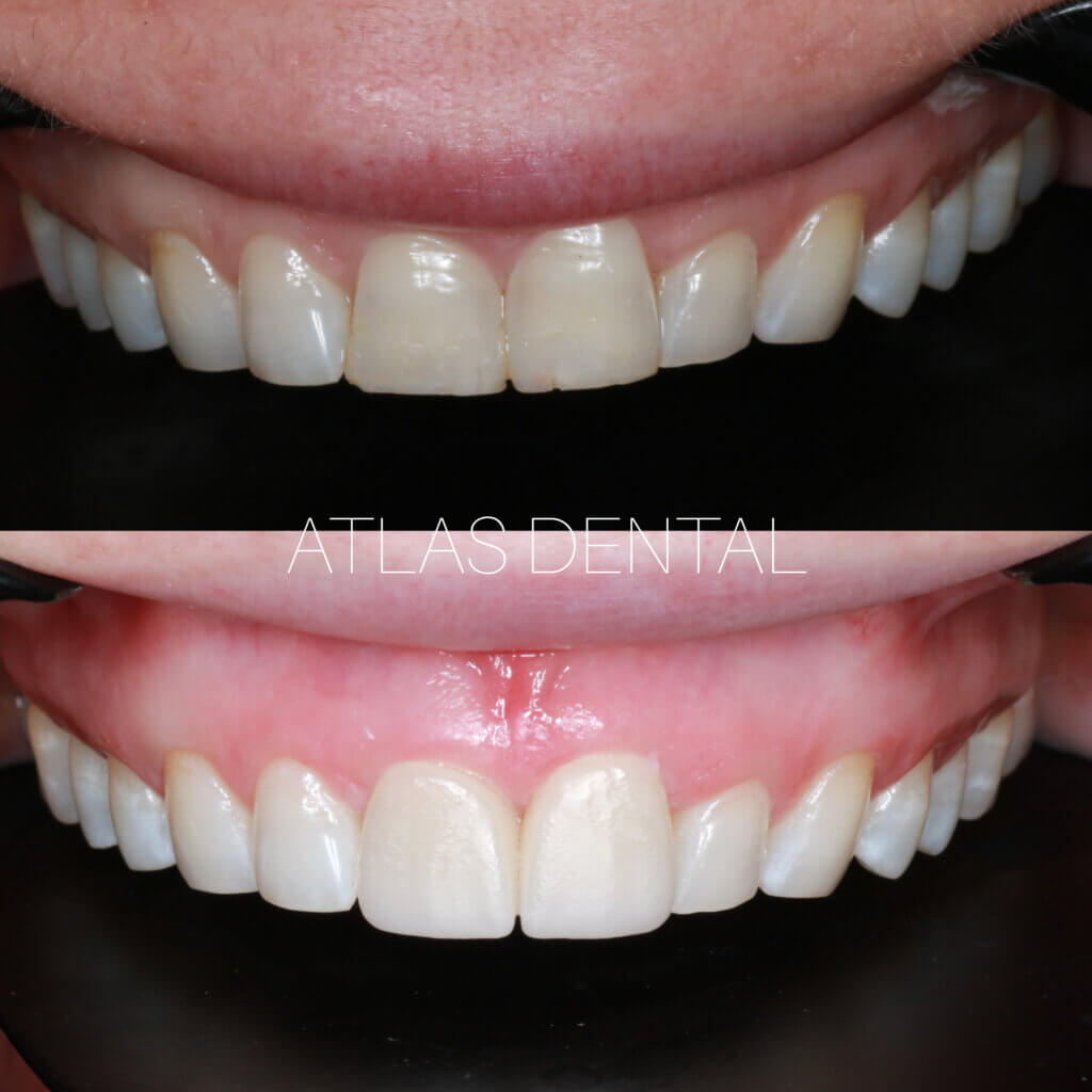 Dental Veneers Toronto