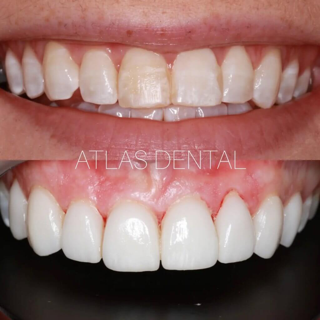 Dental Veneers Toronto