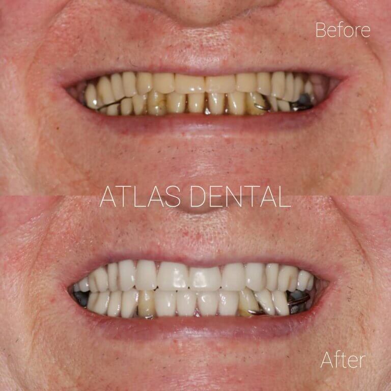 Dentures Toronto