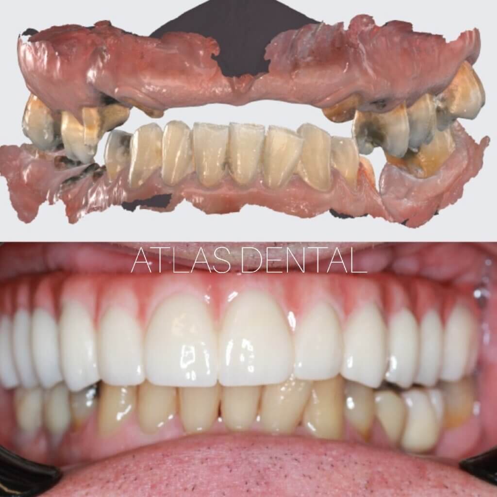 Full arch dental implants intraoral photos