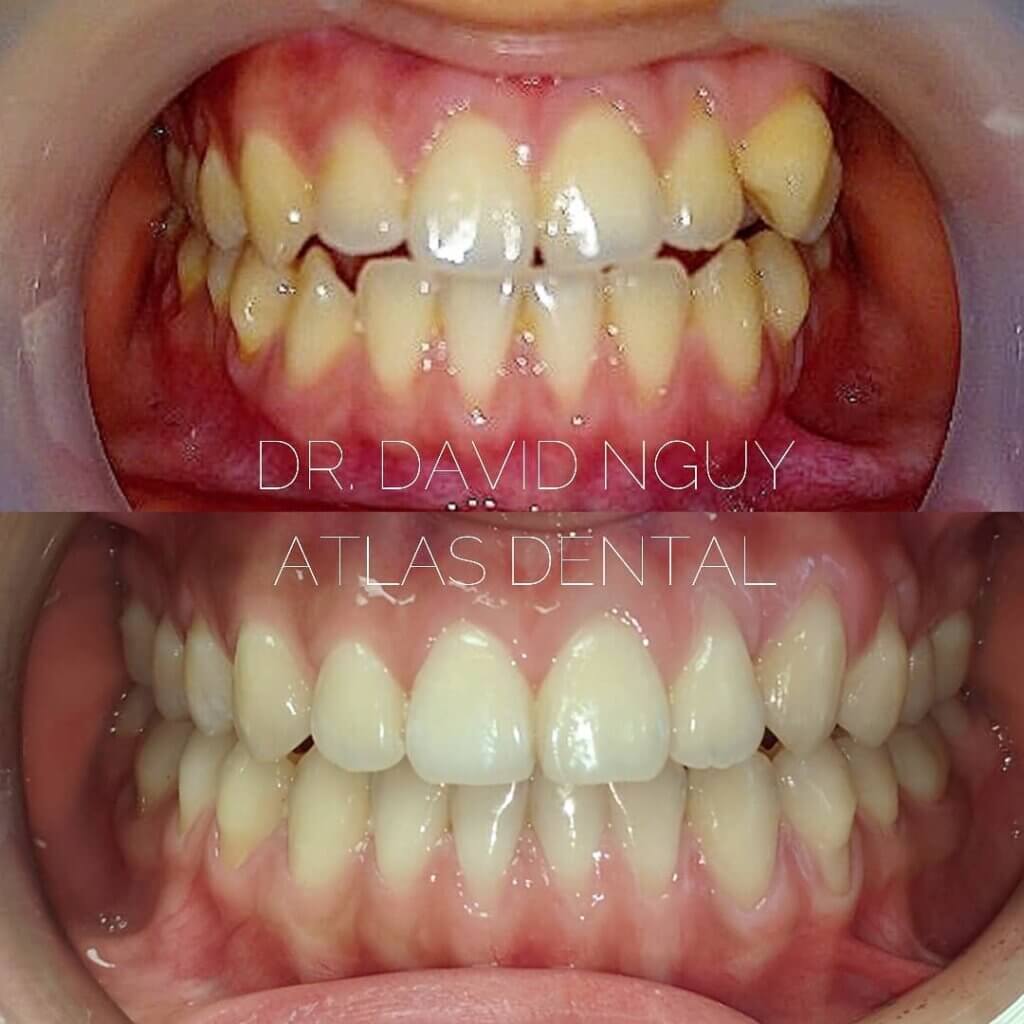 Invisalign Toronto
