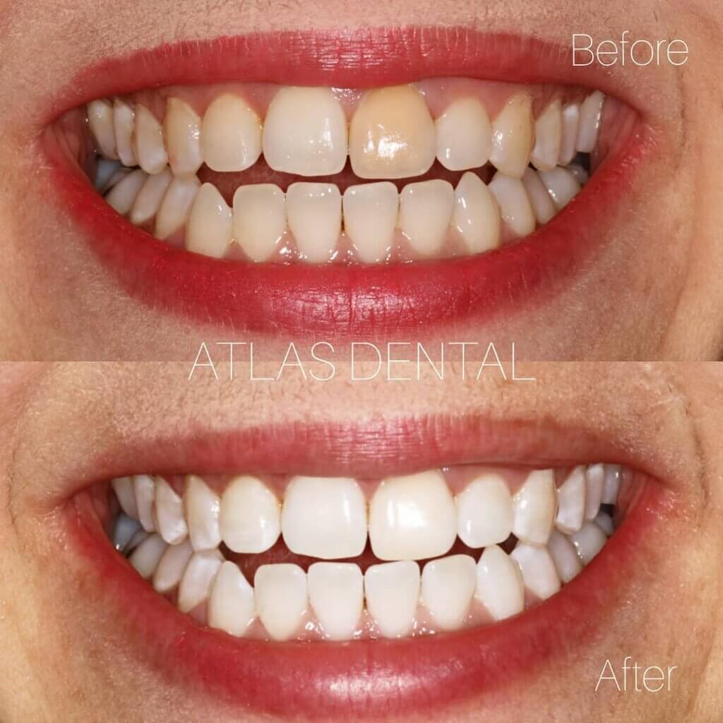 Teeth whitening Toronto