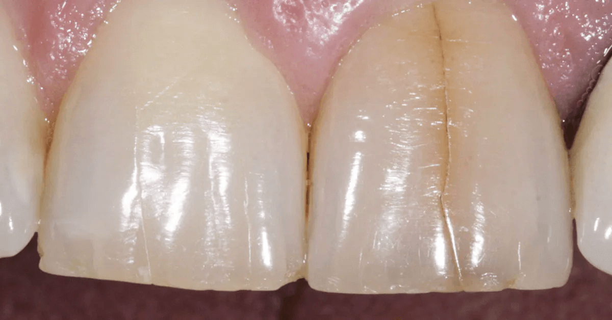 Craze Lines Teeth: Symptoms, Causes & Treatment | Atlas Dental