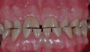 Dental attrition Toronto