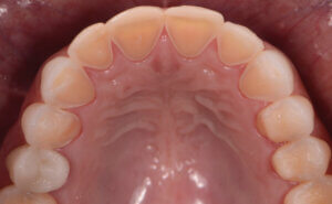 Dental erosion