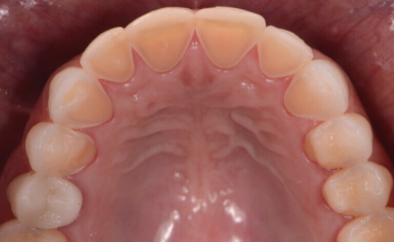 Dental erosion