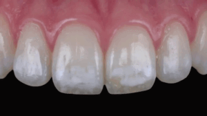Dental fluorosis Toronto