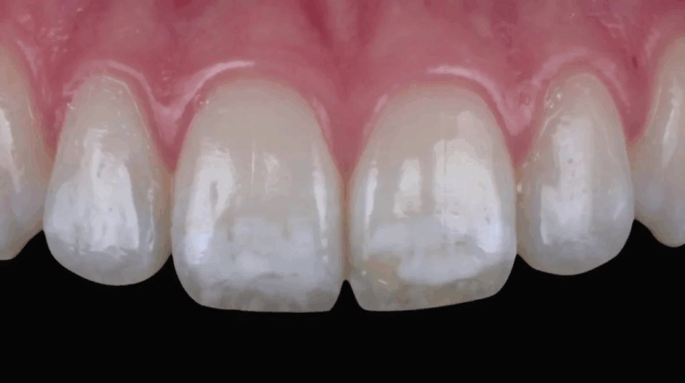 Dental fluorosis Toronto