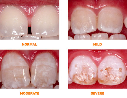Dental fluorosis Toronto mild moderate and severe