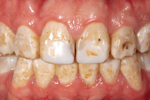 Dental fluorosis Toronto