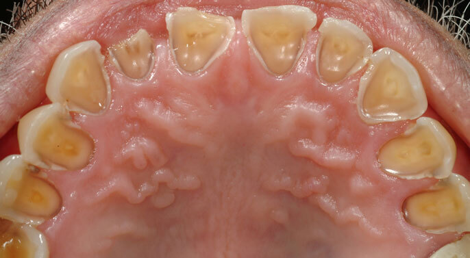 Enamel erosion
