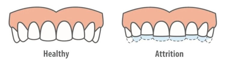 Healthy teeth vs Attrition