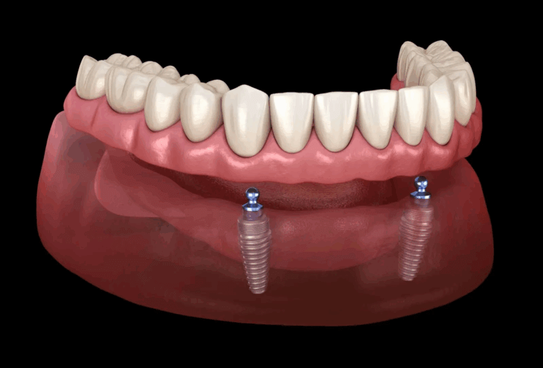 Locator Denture Toronto