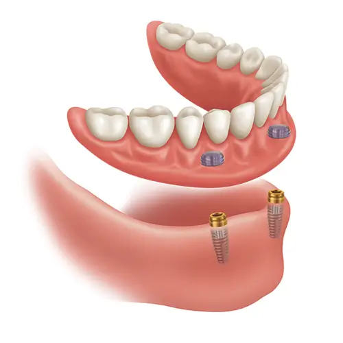 Locator Denture Toronto