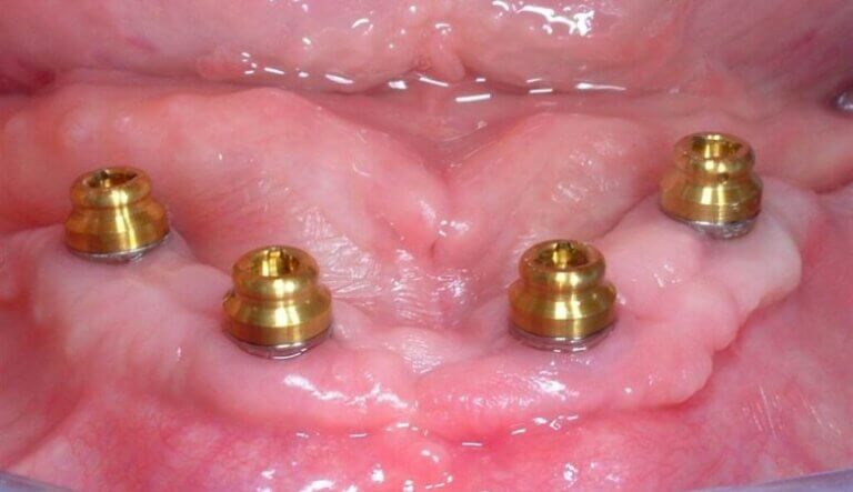 Locator Denture Toronto