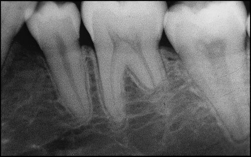 Lower molar root resorption