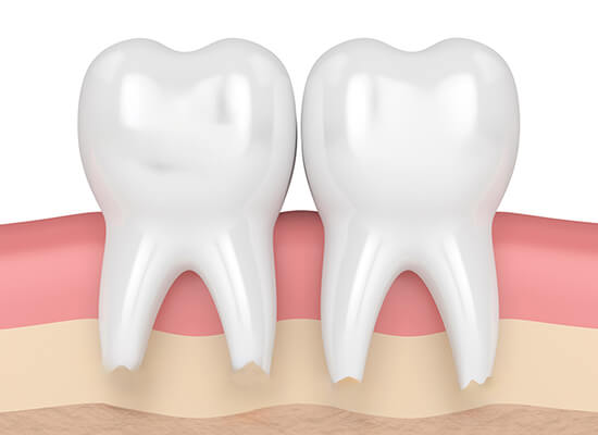 3D render of molar root resorption