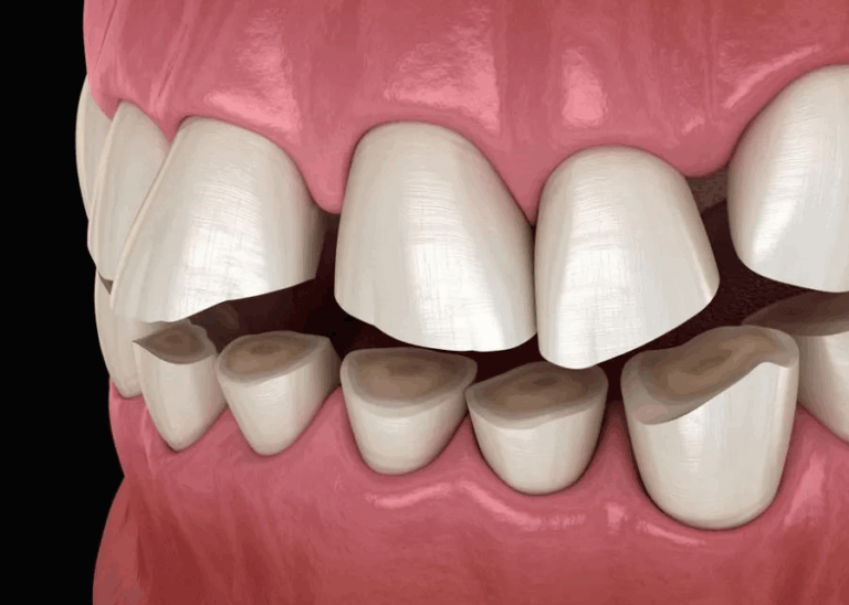 Dental attrition cartoon Toronto