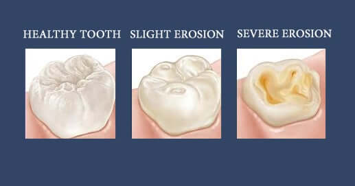 Enamel erosion severity