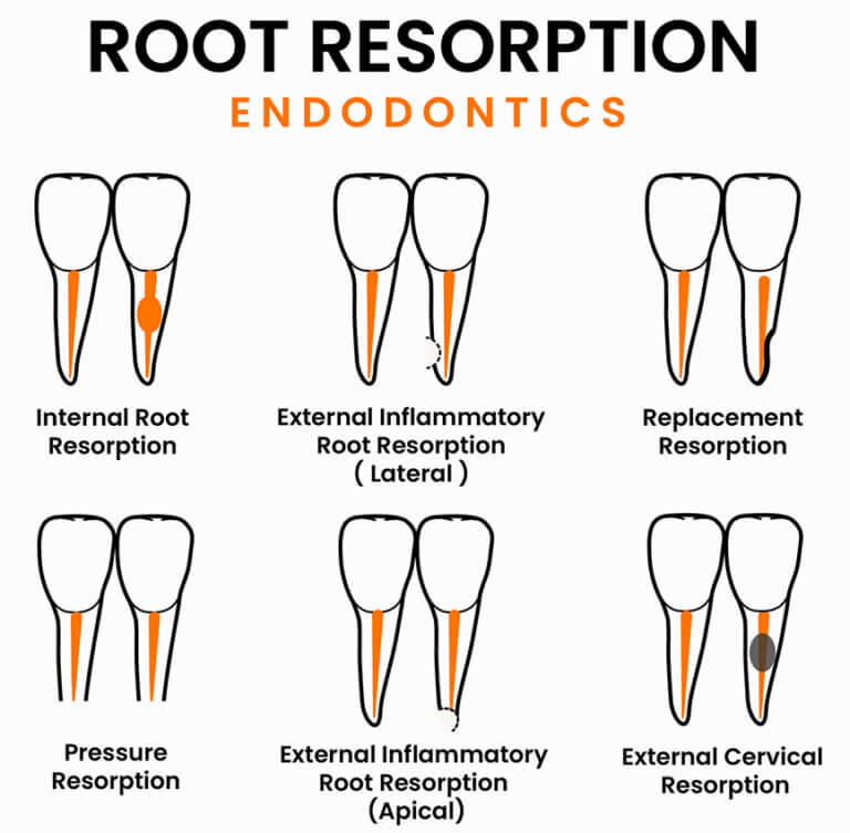 Types of root resorption